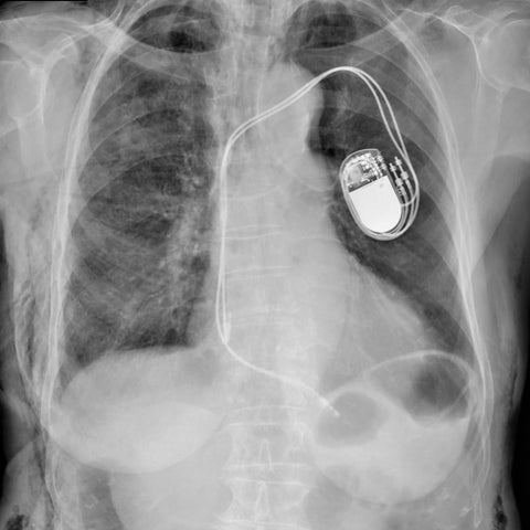 X-ray image of a pacemaker