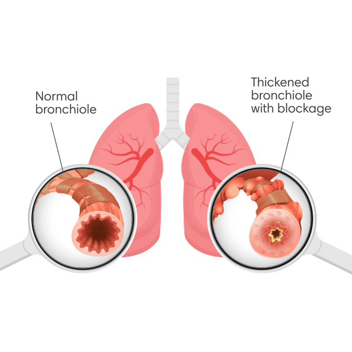 Understanding Lung Crackles