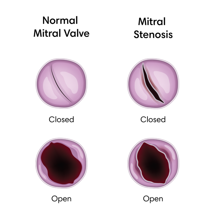 Mitral Stenosis