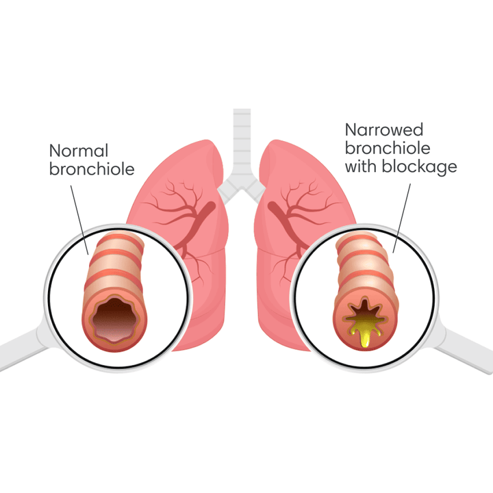 Understanding Lung Wheeze