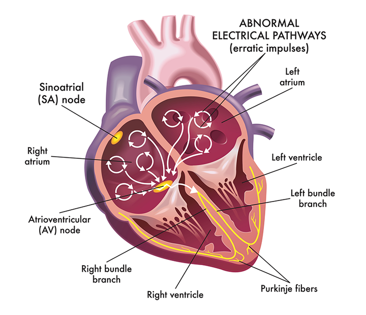 Atrial Fibrillation: Key Facts and Figures