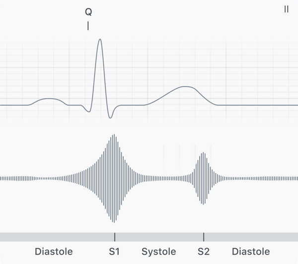 Normal heart sound + ECG with S1, Q wave annotated